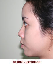 plastic_surgery_augmentation_rhinoplasty